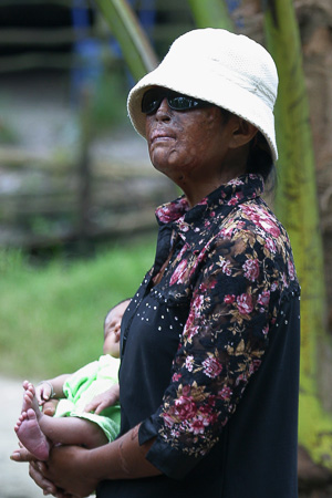 [Photo: Acid Burn Survivor with Child]